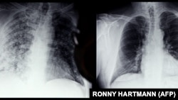 A fotó illusztráció, egy koronavírusos és egy egészséges tüdő látható rajta egy németországi röntgenfelvételen