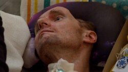 Ukrainian Soldier Fights On At Spanish Clinic After Losing Part Of His Skull 