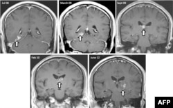 تصویر یک کرم نواری در اسکن‌های MRI مغز که چهار سال در مغز یک بیمار در بریتانیا زندگی کرده بود، ۲۰۱۴