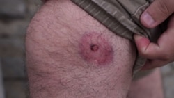 Povrijeđeni novinar tvrdi da je gruzijska policija koristila gumene metke protiv demonstranata