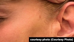 ლელა ჯუღელი, დაზიანება ყვრიმალზე