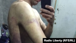 Олексій у записі скайпом показує синці після побиття російськими військовими, які незаконно його захопили і утримували. 25 березня 2022 року