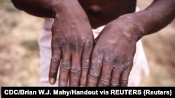 Egy majomhimlőben szenvedő beteg keze. A kép az 1996–97-es járvány idején készült a Kongói Demokratikus Köztársaságban. A betegség évtizedek óta jelen van Afrikában