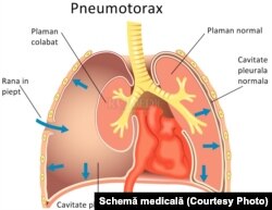 Așa arată plămânul în cazul diagnosticului de pneumotorax