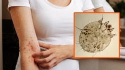 ის, რომ ბოლო პერიოდში, საქართველოში საგრძნობლად იმატა მუნის (სკაბიესის) შემთხვევებმა, ამას რადიო თავისუფლებას უდასტურებს ექიმი დერმატოლოგი.