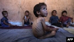 Yazan, një 2-vjeçar palestinez, që vuan nga kequshqyerja. Qyteti i Gazës, 23 korrik 2025. 