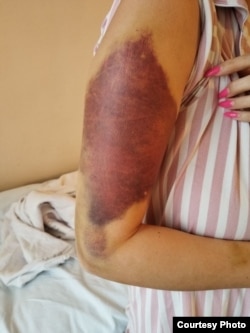 Диния после второго нападения экс-мужа