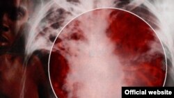 Слухи о том, что 11 человек заразились страшным заболеванием, быстро облетели молодежь