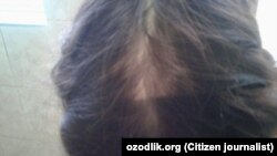 Çaganyň kellesinde tapylan bit (Illýustrasiýa suraty) 